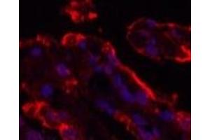 Immunofluorescence analysis of Human lung cancer tissue using Galectin 3 Monoclonal Antibody at dilution of 1:200. (Galectin 3 Antikörper)