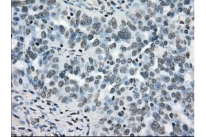 Immunohistochemical staining of paraffin-embedded colon tissue using anti-BRAFmouse monoclonal antibody. (BRAF Antikörper)