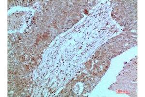 Immunohistochemical analysis of paraffin-embedded Human Breast Carcinoma Tissue using JAK2 Mouse mAb diluted at 1:2000 (JAK2 Antikörper)