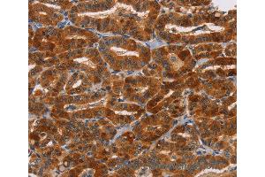 Immunohistochemistry of Human liver cancer using NCR1 Polyclonal Antibody at dilution of 1:30 (NCR1 Antikörper)