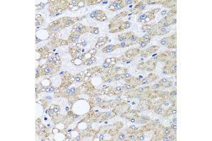 Immunohistochemistry of paraffin-embedded human liver damage using SRI antibody  at dilution of 1:100 (40x lens). (SRI Antikörper  (AA 1-198))