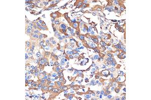 Immunohistochemistry of paraffin-embedded human lung cancer using VPS28 Rabbit mAb (ABIN7271275) at dilution of 1:100 (40x lens). (VPS28 Antikörper)