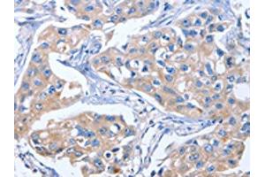 The image on the left is immunohistochemistry of paraffin-embedded Human breast cancer tissue using ABIN7191031(IBSP Antibody) at dilution 1/50, on the right is treated with synthetic peptide. (IBSP Antikörper)