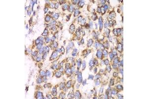Immunohistochemistry of paraffin-embedded human esophageal cancer using ATP5A1 antibody. (ATP5A1 Antikörper)