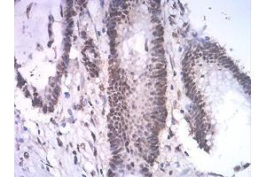 Immunohistochemical analysis of paraffin-embedded colon cancer tissues using ASH2L mouse mAb with DAB staining. (ASH2L Antikörper  (AA 493-628))