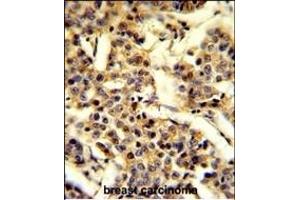 Formalin-fixed and paraffin-embedded human breast carcinoma reacted with CYP2A13 Antibody (C-term), which was peroxidase-conjugated to the secondary antibody, followed by DAB staining. (CYP2A13 Antikörper  (C-Term))