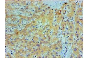 Immunohistochemical of paraffin-embedded Human live cancer tissue using ABIN7156047 at dilution of 1:200. (IL1A Antikörper)