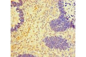 Immunohistochemistry of paraffin-embedded human ovarian cancer using ABIN7150987 at dilution of 1:100 (RNF2 Antikörper  (AA 1-100))