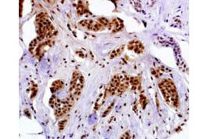 Immunohistochemistry (IHC) image for anti-Melanoma Antigen Family A, 4 (MAGEA4) antibody (ABIN3002532) (MAGEA4 Antikörper)