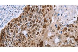 Immunohistochemistry of paraffin-embedded Human esophagus cancer using MAGEA10 Polyclonal Antibody at dilution of 1:50 (MAGEA10 Antikörper)