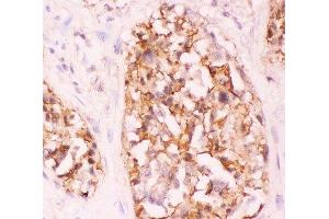 IHC-P: Crk antibody testing of human lung cancer tissue (Crk Antikörper  (AA 2-246))