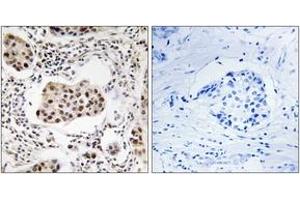 Immunohistochemistry analysis of paraffin-embedded human breast carcinoma tissue, using PPP1R11 Antibody. (PPP1R11 Antikörper  (AA 71-120))