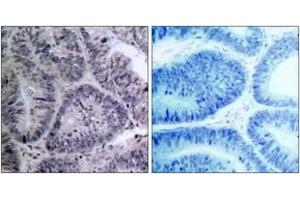 Immunohistochemistry analysis of paraffin-embedded human colon carcinoma tissue, using IKK-alpha (Ab-23) Antibody. (IKK alpha Antikörper  (AA 15-64))
