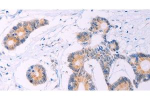 Immunohistochemistry of paraffin-embedded Human colon cancer tissue using ADCY5 Polyclonal Antibody at dilution 1:30 (ADCY5 Antikörper)