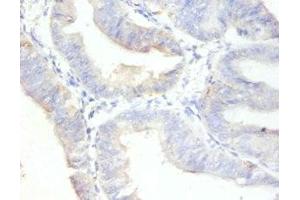 Immunohistochemistry of paraffin-embedded human endometrial cancer using ABIN7164742 at dilution of 1:100 (Ki-67 Antikörper  (AA 3120-3256))