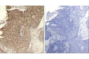 Immunohistochemical analysis of paraffin-embedded human breast carcinoma tissue using HDAC2 (Phospho- Ser394) antibody (E011191). (HDAC2 Antikörper  (pSer394))
