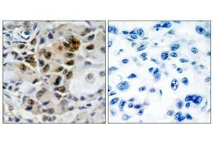 Immunohistochemical analysis of paraffin-embedded human lung carcinoma tissue, using AFX (Ab-197) antibody (E0 21162 ). (FOXO4 Antikörper)