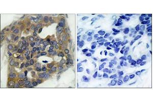 Immunohistochemical analysis of paraffin-embedded human breast carcinoma tissue, using ASK1 (phospho-Ser966) antibody (E011179). (ASK1 Antikörper  (pSer966))