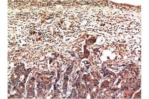 Immunohistochemical analysis of paraffin-embedded Human Stomach Carcinoma Tissue using Ubiquitin Mouse mAb diluted at 1:200. (Ubiquitin Antikörper)