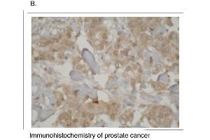 Immunohistochemistry staining of prostate cancer tissue using CYP3A7 antibody. (CYP3A7 Antikörper  (C-Term))