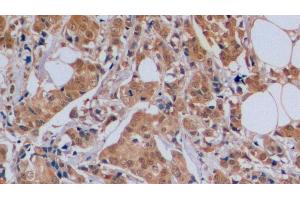 Detection of CDKN1B in Human Breast cancer Tissue using Polyclonal Antibody to Cyclin Dependent Kinase Inhibitor 1B (CDKN1B) (CDKN1B Antikörper  (AA 1-198))
