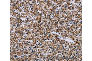 Immunohistochemistry of Human prostate cancer using GTPBP10 Polyclonal Antibody at dilution of 1:60 (GTPBP10 Antikörper)