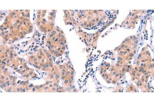Immunohistochemistry of paraffin-embedded Human lung cancer tissue using VWF Polyclonal Antibody at dilution 1:50 (VWF Antikörper)
