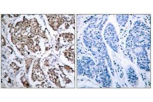 Immunohistochemical analysis of paraffin-embedded human breast carcinoma tissue using BAD (phospho- Ser155) antibody. (BAD Antikörper  (pSer155))