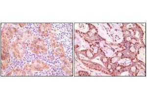 Immunohistochemical analysis of paraffin-embedded human ovary carcinoma (left) and breast carcinoma (right), showing cytoplasmic(ovary carcinoma) localization, cytoplasmic and nuclear (breast carcinoma) localization using SNCG mouse mAb with DAB staining. (SNCG (Breast Cancer-Specific Protein 1) Antikörper)