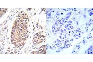 Immunohistochemical analysis of paraffin- embedded human breast carcinoma tissue using FOXO3A (Ab-253) antibody (E022020). (FOXO3 Antikörper)
