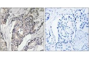 Immunohistochemistry analysis of paraffin-embedded human breast carcinoma, using THBS4 Antibody. (THBS4 Antikörper  (AA 561-610))