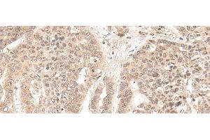 Immunohistochemistry of paraffin-embedded Human liver cancer tissue using EXOSC9 Polyclonal Antibody at dilution of 1:35(x200) (EXOSC9 Antikörper)