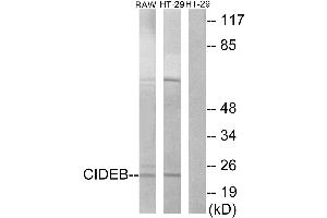 Immunohistochemistry analysis of paraffin-embedded human cervix carcinoma tissue using CIDEB antibody. (CIDEB Antikörper  (Internal Region))