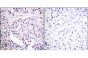 Immunohistochemistry analysis of paraffin-embedded human breast carcinoma tissue, using p53 (Ab-392) Antibody. (p53 Antikörper  (AA 344-393))