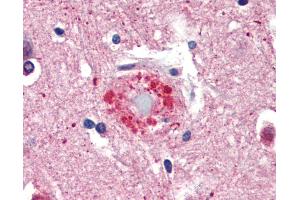 Anti-Ubiquitin antibody IHC of human brain, cortex, senile plaque. (Ubiquitin Antikörper)