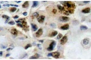 Immunohistochemistry (IHC) analyzes of FoxO4 antibody in paraffin-embedded human breast carcinoma tissue. (FOXO4 Antikörper)