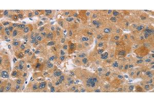 Immunohistochemistry of paraffin-embedded Human liver cancer using CYP4A11 Polyclonal Antibody at dilution of 1:30 (CYP4A11 Antikörper)