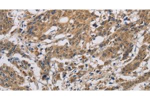 Immunohistochemistry of paraffin-embedded Human gastric cancer using CYCS Polyclonal Antibody at dilution of 1:50 (Cytochrome C Antikörper)