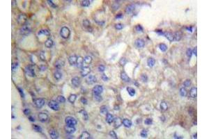 Immunohistochemistry analyzes of Flg antibody in paraffin-embedded human breast carcinoma tissue. (FGFR1 Antikörper)