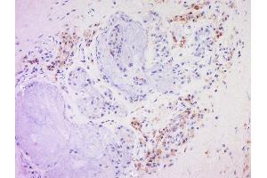 Formalin-fixed and paraffin embedded human larynocarcinoma labeled with Anti-CD20 Polyclonal Antibody, Unconjugated  at 1:200 followed by conjugation to the secondary antibody and DAB staining. (CD20 Antikörper  (AA 133-182))