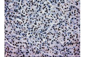 Immunohistochemical staining of paraffin-embedded Adenocarcinoma of colon tissue using anti-MAPK1mouse monoclonal antibody. (ERK2 Antikörper)