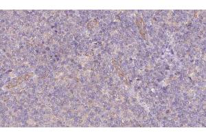 ABIN6273074 at 1/100 staining Human lymph cancer tissue by IHC-P. (SNAPIN Antikörper  (N-Term))