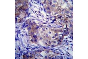 CYP1A1 antibody immunohistochemistry analysis in formalin fixed and paraffin embedded human breast carcinoma. (CYP1A1 Antikörper  (AA 252-280))