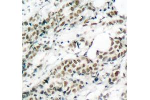 Immunohistochemistry of paraffin-embedded human breast carcinoma tissue, using Phospho-FOXO4-S197 antibody (ABIN3019724, ABIN3019725, ABIN3019726 and ABIN1681609). (FOXO4 Antikörper  (pSer197))