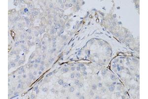 Immunohistochemistry of paraffin-embedded human breast cancer using CD34 antibody (ABIN5970285) at dilution of 1:50 (40x lens). (CD34 Antikörper)
