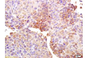 Formalin-fixed and paraffin embedded human bladder carcinoma labeled with Anti-Cancer/testis antigen 1B/1A Polyclonal Antibody, Unconjugated (ABIN1385260) at 1:200 followed by conjugation to the secondary antibody and DAB staining. (Testis Antigen 1 (AA 75-180) Antikörper)