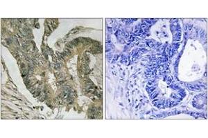 Immunohistochemistry analysis of paraffin-embedded human colon carcinoma tissue, using ALDOC Antibody. (ALDOC Antikörper  (AA 61-110))