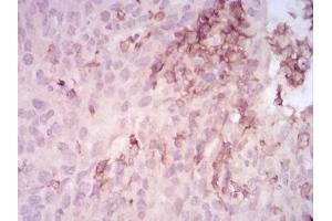 Immunohistochemical analysis of paraffin-embedded ovarian cancer tissues using MMP14 mouse mAb with DAB staining. (MMP14 Antikörper  (AA 112-246))