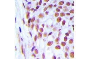 Immunohistochemical analysis of DNA Ligase 1 staining in human breast cancer formalin fixed paraffin embedded tissue section. (LIG1 Antikörper  (N-Term))