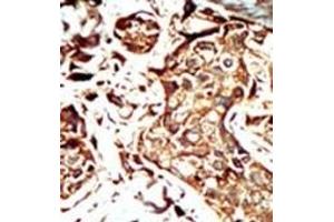Formalin-fixed and paraffin-embedded human cancer tissue reacted with the primary antibody, which was peroxidase-conjugated to the secondary antibody, followed by AEC staining. (BRD3 Antikörper  (C-Term))